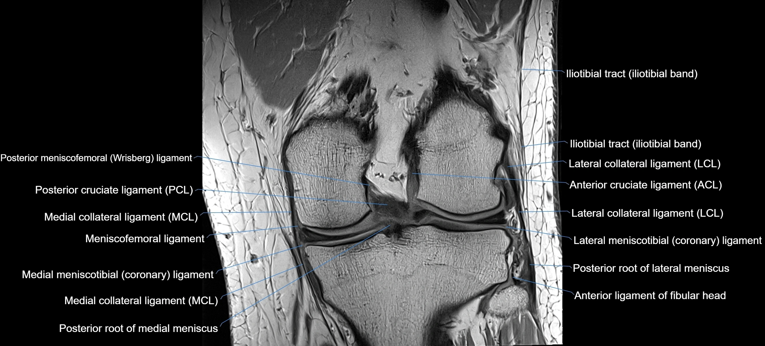 MRI coronal  ligaments cross sectional anatomy 3T  radiology  image-img-04001-00024.webp